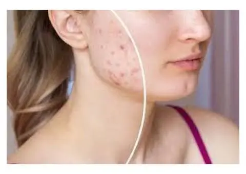 Best Facials for Acne Scars in Sydney | Clearer Skin