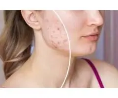 Best Facials for Acne Scars in Sydney | Clearer Skin