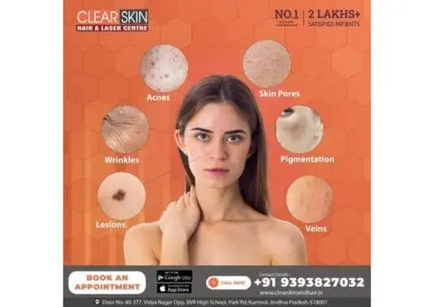 Pulse dye laser treatment in india