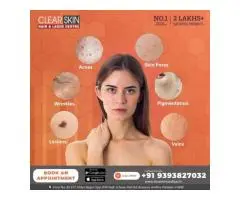 Pulse dye laser treatment in india