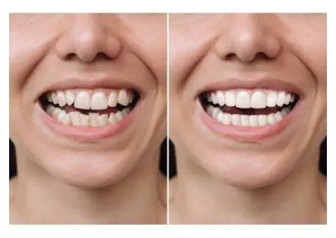 Achieve a Perfect Smile with Clear Smile Braces