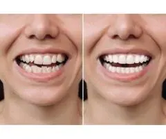 Achieve a Perfect Smile with Clear Smile Braces