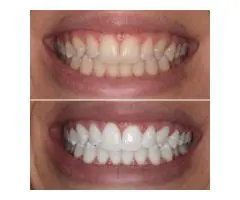 Tooth Bleaching Solutions with Modern Techniques
