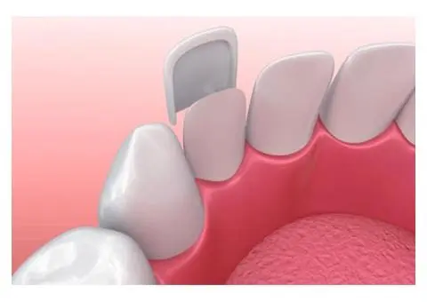 Dental Veneers Canberra
