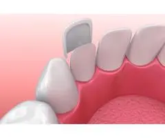 Dental Veneers Canberra