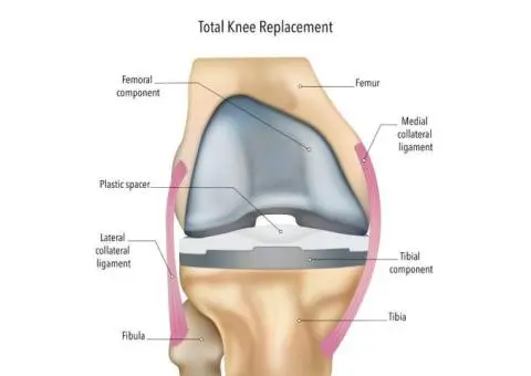 Opt for Reliable Total Knee Joint Replacement