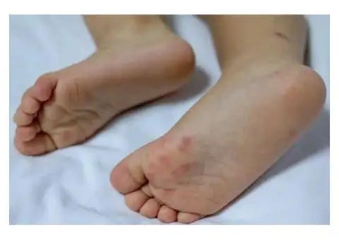 Learn About Paediatric Athletes Foot from The Top Child Care Programs Jandakot