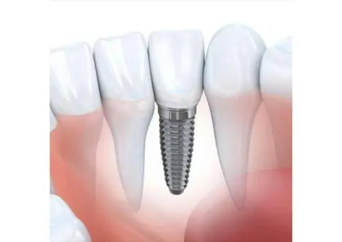 Dental Implants Canberra