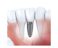 Dental Implants Canberra