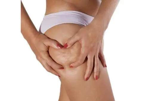 Professional Cellulite Reduction Treatment for Smoother & Firmer Skin