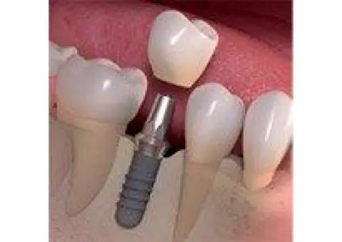 How can Dental Implant Treatment restore your confidence?