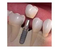 How can Dental Implant Treatment restore your confidence?