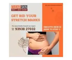 best vbeam laser treatment in india