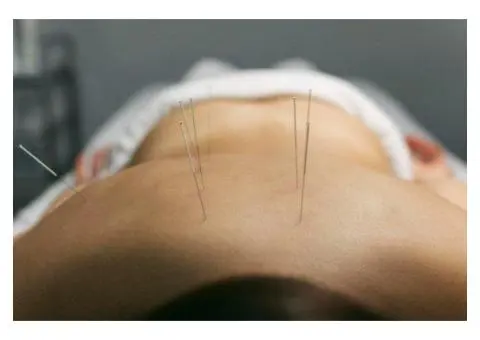 Best Acupuncture Perth | 777 Health Care