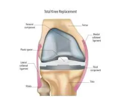 Knee Replacement Surgery Helps You Move and Feel Better