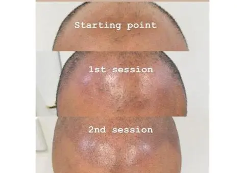 Restore Your Hairline: Scalp Micropigmentation Sydney