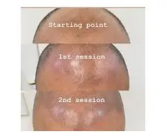 Restore Your Hairline: Scalp Micropigmentation Sydney