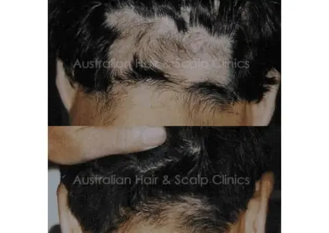 Natural Hair Restoration Treatment in Sydney
