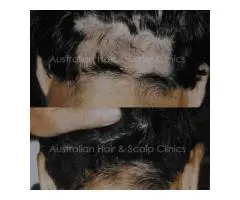 Natural Hair Restoration Treatment in Sydney