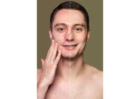 Pigmentation Removal Myths: Separating Fact from Fiction in Sydney