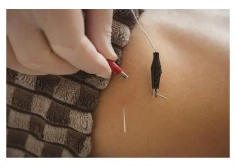 Healing Acupuncture Perth | Natural Wellness Care