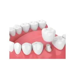 Expert Dentists Dandenong | Supra Dental