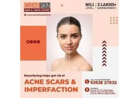 best pulsed dye laser treatment in india