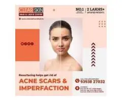 best pulsed dye laser treatment in india