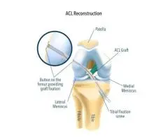 Get Moving Again with ACL Ligament Reconstruction