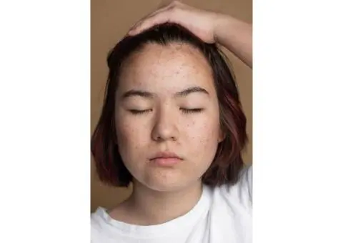 The 6 Mistakes People Make When Choosing Pigmentation Removal in Sydney (and How to Avoid Them)