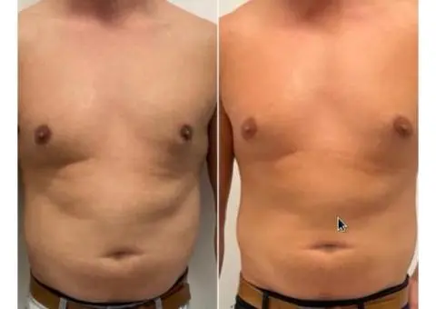 Experience expert Fat Freezing near Gold Coast for real results