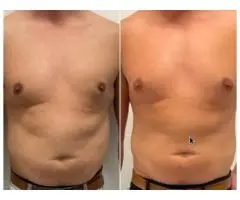 Experience expert Fat Freezing near Gold Coast for real results