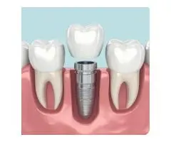 Root Canal Treatment Penrith