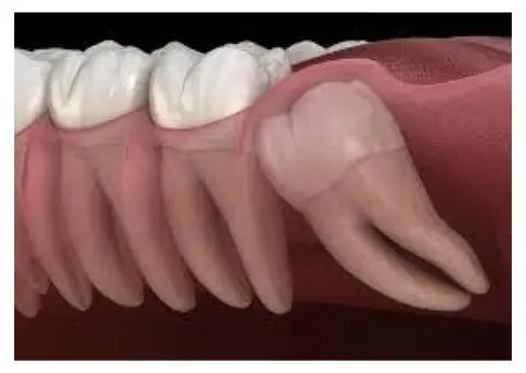 Safe and Painless Surgical Tooth Removal Services Available Now