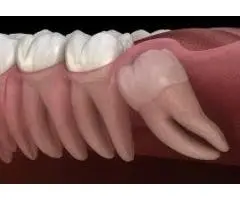 Safe and Painless Surgical Tooth Removal Services Available Now