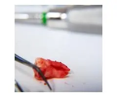 Affordable Wisdom Teeth Melbourne Services