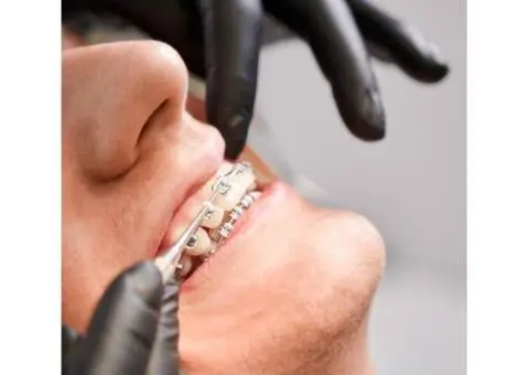 Damon Braces Treatment