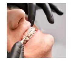 Damon Braces Treatment