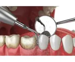 Teeth Cleaning Penrith