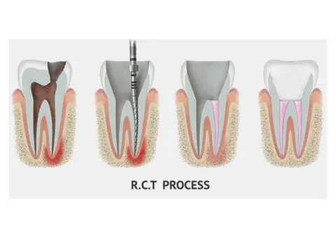 Save Your Tooth – Advanced Root Canal Treatment in Noida