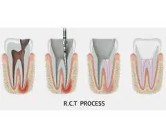 Save Your Tooth – Advanced Root Canal Treatment in Noida