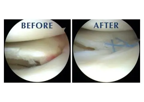 Restore Knee Strength with Expert Meniscus Repair Surgery