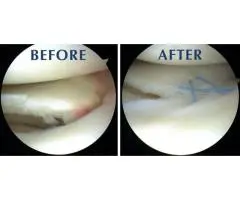 Restore Knee Strength with Expert Meniscus Repair Surgery