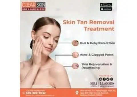 Best Birthmark removal laser treatment in india