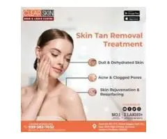 Best Birthmark removal laser treatment in india