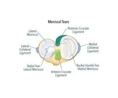 Fast Knee Relief: Effective Surgery for Meniscus Tear