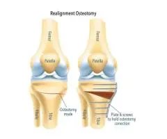 Osteotomy Surgery for Better Knee Balance