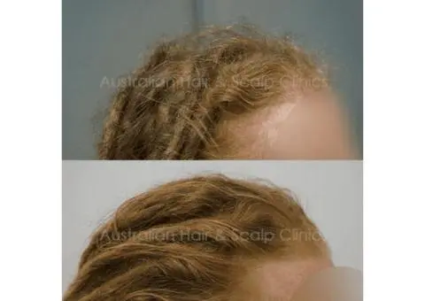 Effective Hair Loss Treatment Brisbane