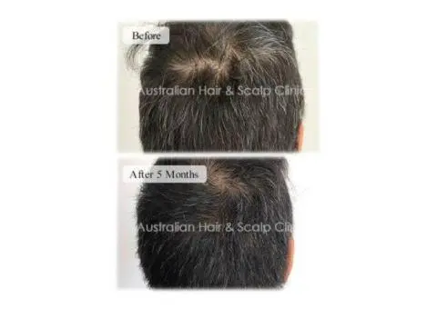 Bring Back Natural Colour with Grey Hair Treatment