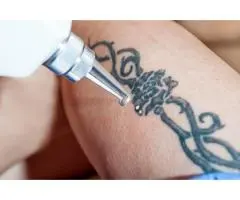 Tattoo Removal in Sydney – Safe, Fast & Effective